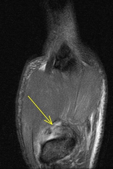Figure 3 for case trapeziometacarpal dislocation